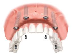 www.thedentalimplantcenterlv.com