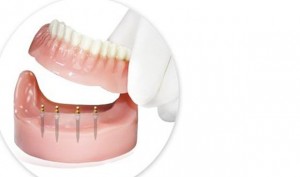 Mini Implants with Denture